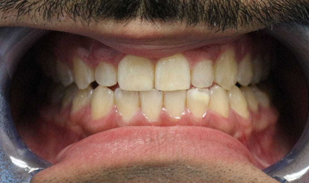 What Are The Process And Advantages Of Tooth Filling?