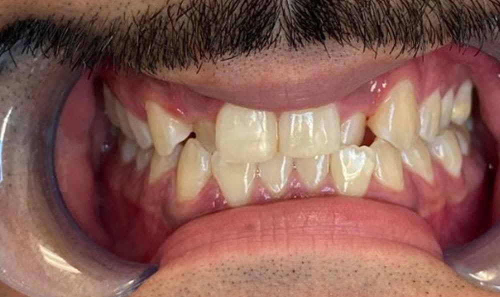 What Are The Treatment For Periodontitis?