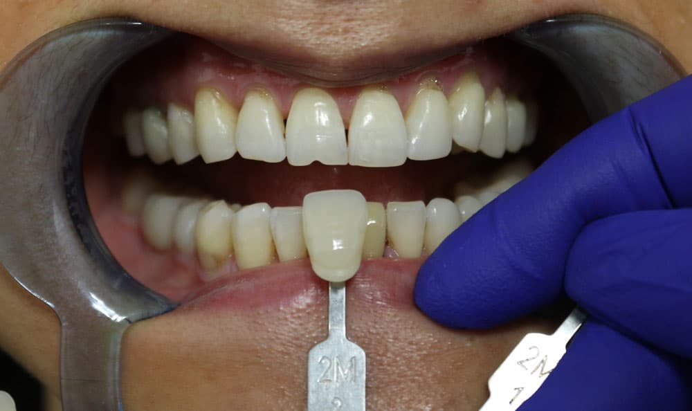 What are Dental implants and their types?