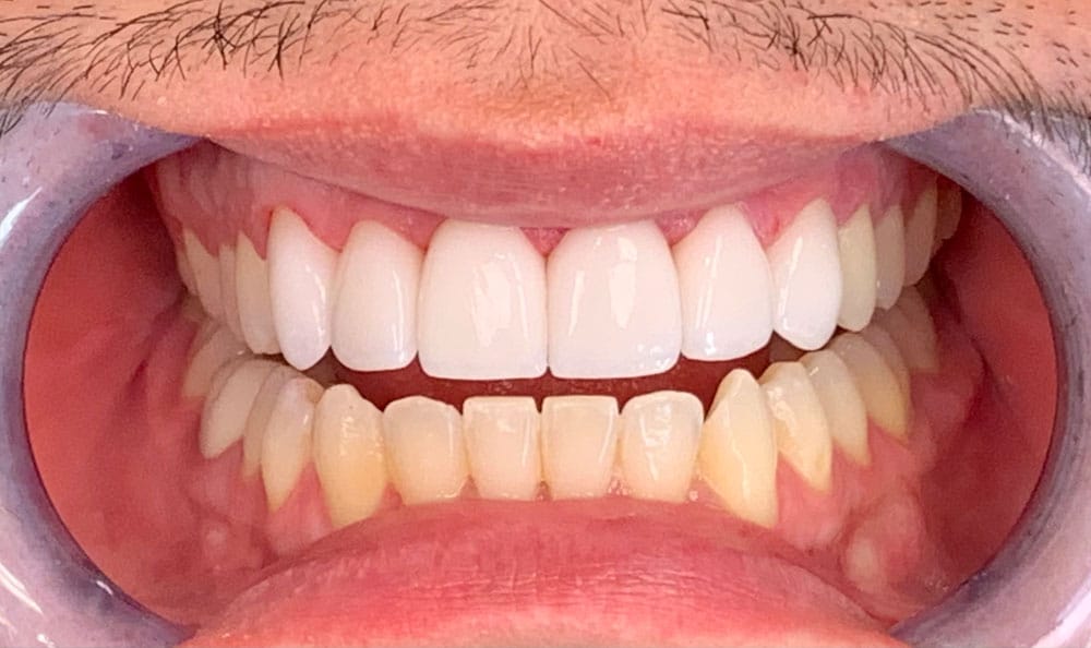 What Are The Advantages Of The Teeth Whitening Process?