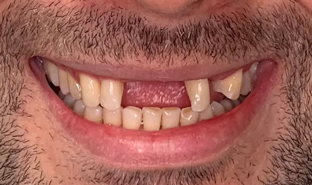 dental implants before