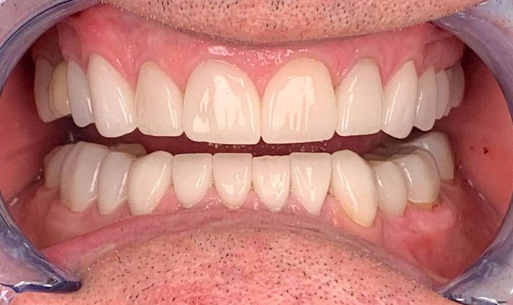 veneers after