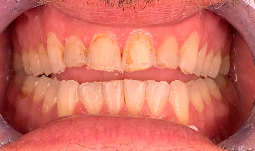before & after veneers