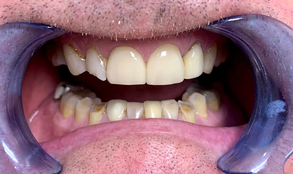 veneers before